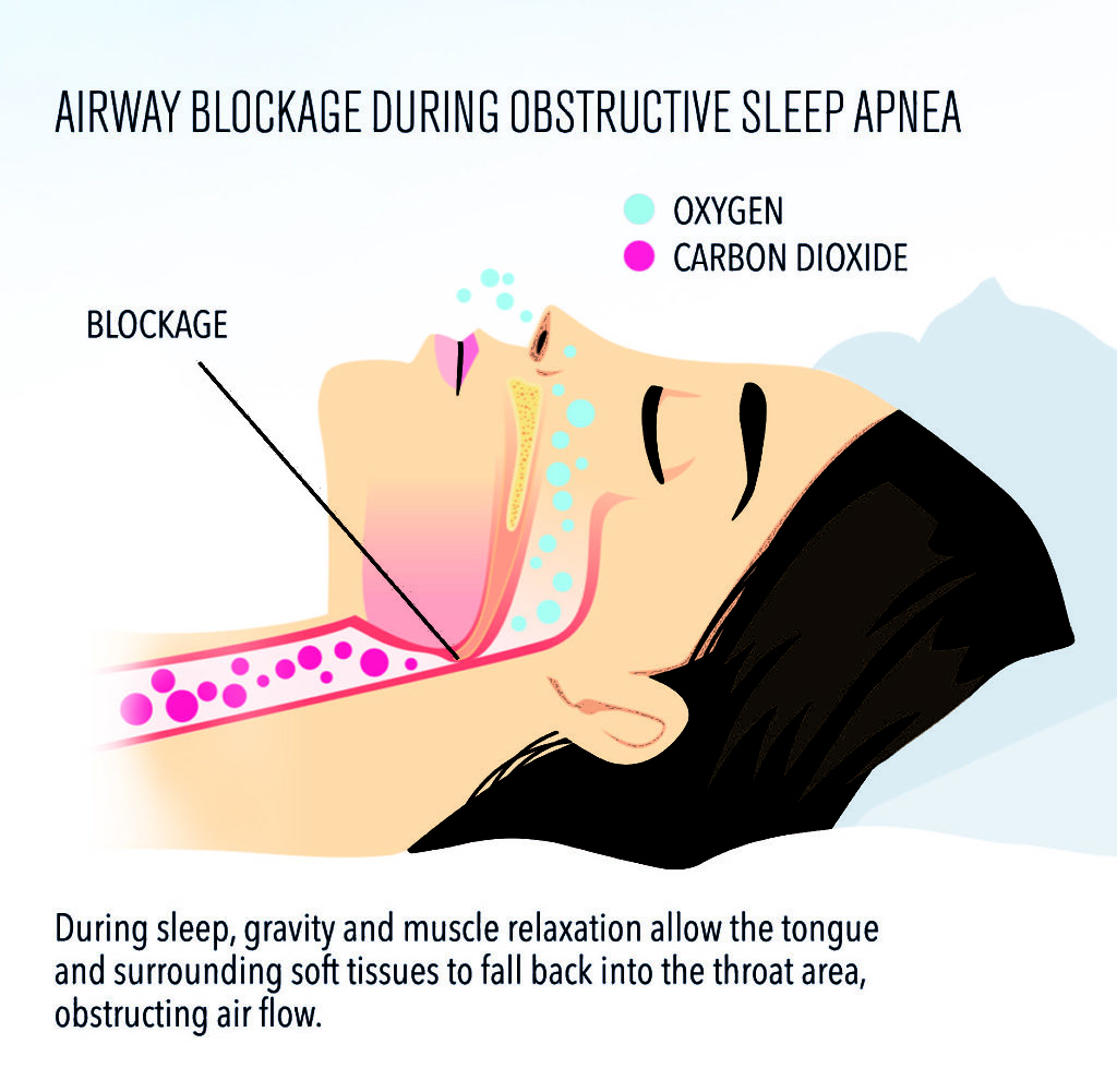 Sleep Apnea Blockage